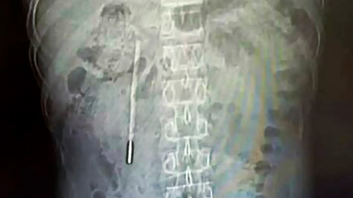 ২০ বছর পেটে থার্মোমিটার, হঠাৎ ব্যথায় সামনে এল অবাক করা ঘটনা