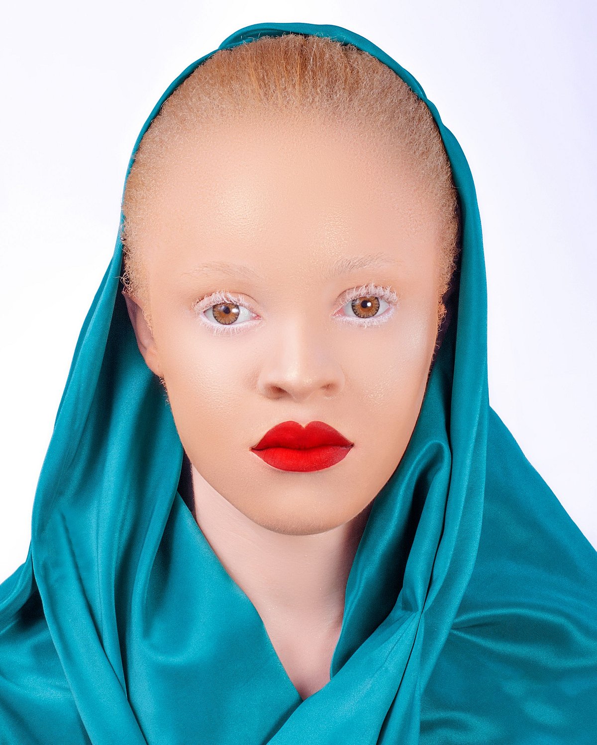 মেলানিনের ঘাটতিতে হয় অ্যালবিনিজম