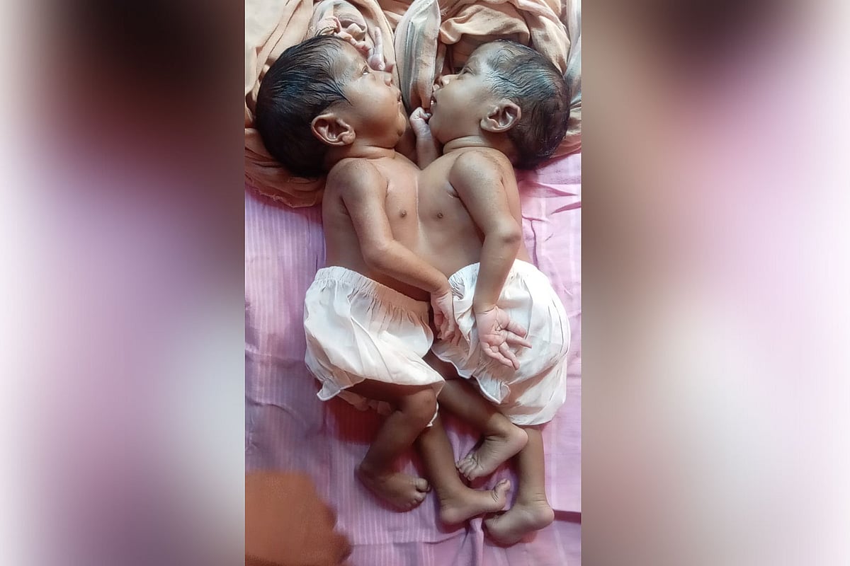 জোড়া লাগানো যমজ শিশুর পরিবার আর্থিক সংকটে, অনিশ্চিত আলাদা হওয়ার চিকিৎসা