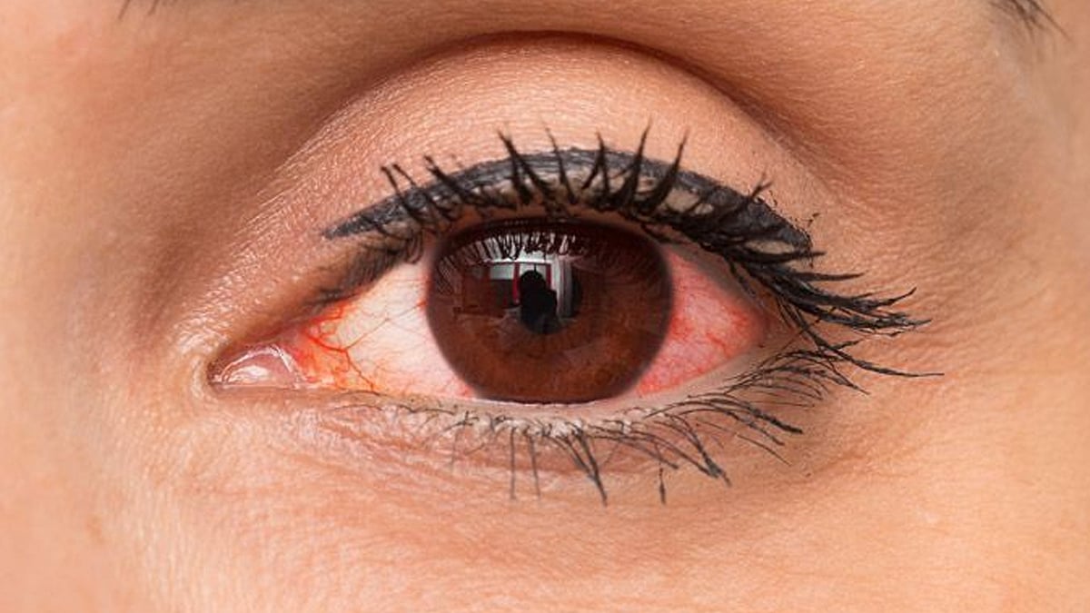 কিডনিতে সমস্যা হলে তার প্রভাব চোখেও দেখা দিতে পারে