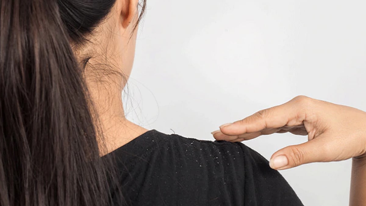 খুশকি এ সময় এক বিরাট ঝক্কি হয়ে দাঁড়াতে পারে