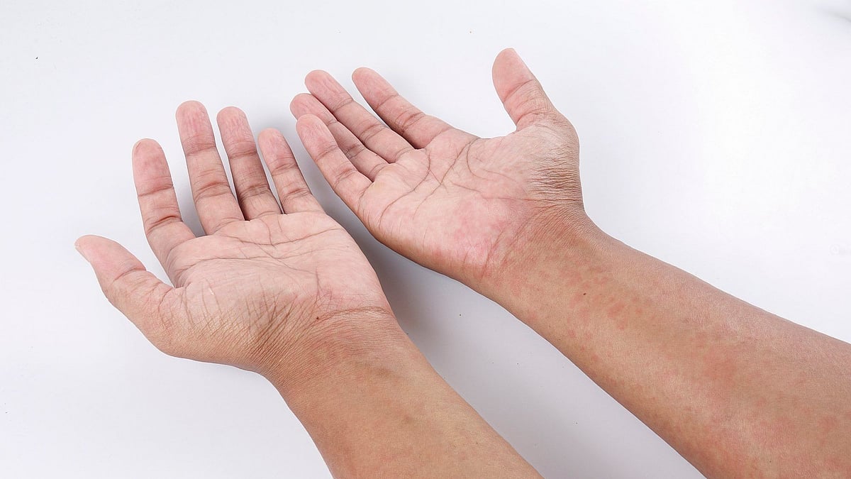 স্টিভেন জনসন সিনড্রোমে ত্বকে ক্ষত তৈরি হয়