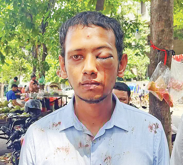 চোখে আঘাত পাওয়া নাফিস আহসান। হাসপাতালে চিকিৎসা নিতে যাওয়ার পর তোলা