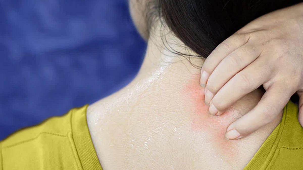 ঘামাচি বা র‍্যাশ হলে ঢিলেঢালা পোশাক পরুন