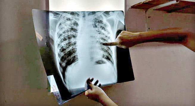 আগামীর বাংলাদেশের কথা বিবেচনা করেই গ্রাম থেকে শহর, সীমান্ত থেকে প্রত্যন্ত অঞ্চলে যক্ষ্মা নিয়ে সচেতনতা বাড়াতে হবে।