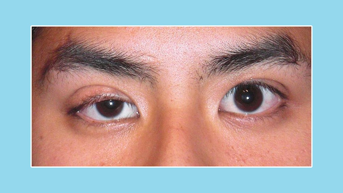 চোখের পাতা ঝুলে যাওয়ার সমস্যাকে বলা হয় ড্রুপি আইলিড