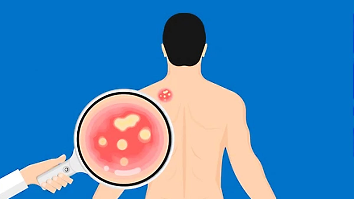 বয়েল ও কারবাংকল মূলত ত্বকের রোগ