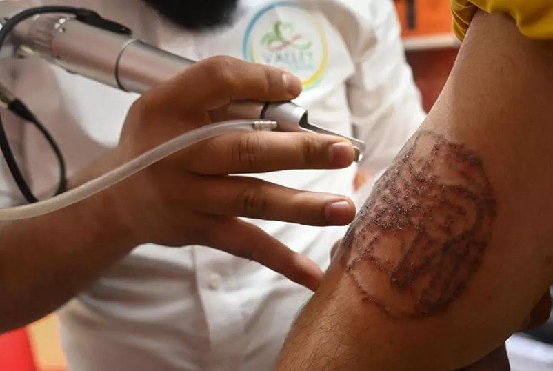 পুলিশের হয়রানির ভয়ে কাশ্মীরের হাজার হাজার মানুষ ‘প্রতিবাদী ট্যাটু’ মুছে ফেলছেন