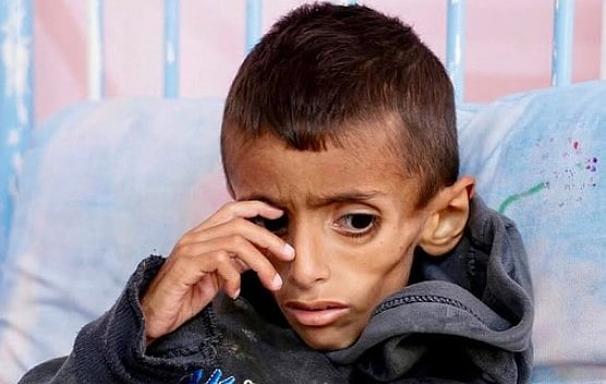 গাজায় খাদ্যাভাবে-অনাহারে মারা যাচ্ছে শিশুরা