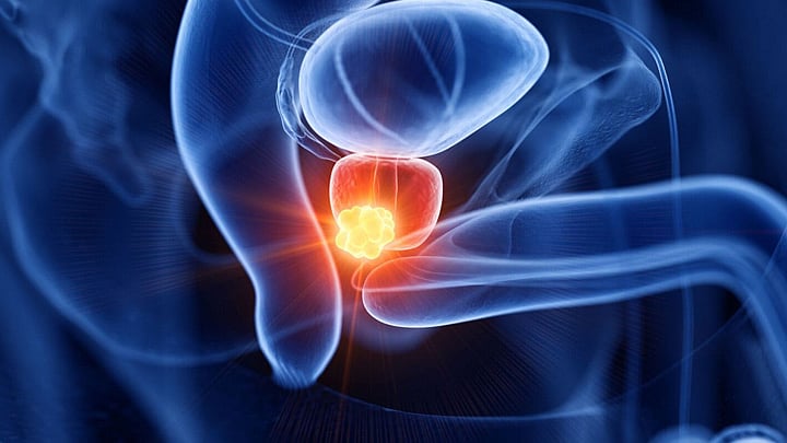 বাংলাদেশসহ সারা বিশ্বে প্রোস্টেট ক্যানসার পুরুষদের জন্য একটি ক্রমবর্ধমান স্বাস্থ্যঝুঁকি