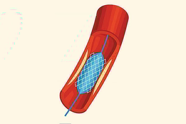 করোনারি স্টেন্ট