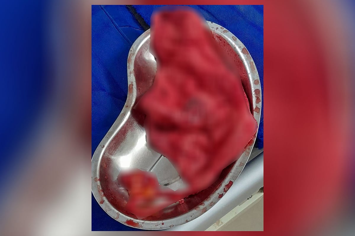 নারীর পেট থেকে বের করা গজ কাপড়