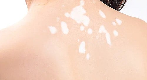 শ্বেতী সাধারণত জেনেটিক বা বংশগত কারণে হয়