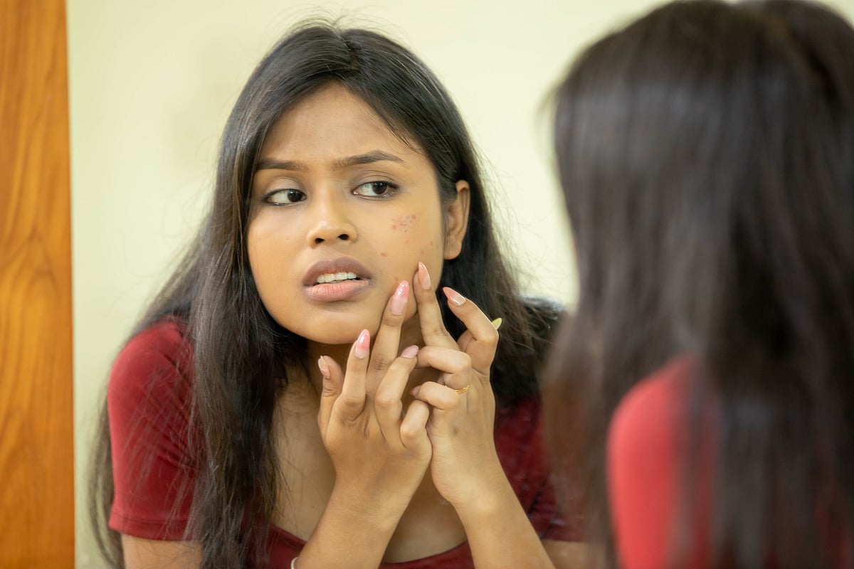 অনেক সময় ব্রণের দাগ সহজে দূর হতে চায় না