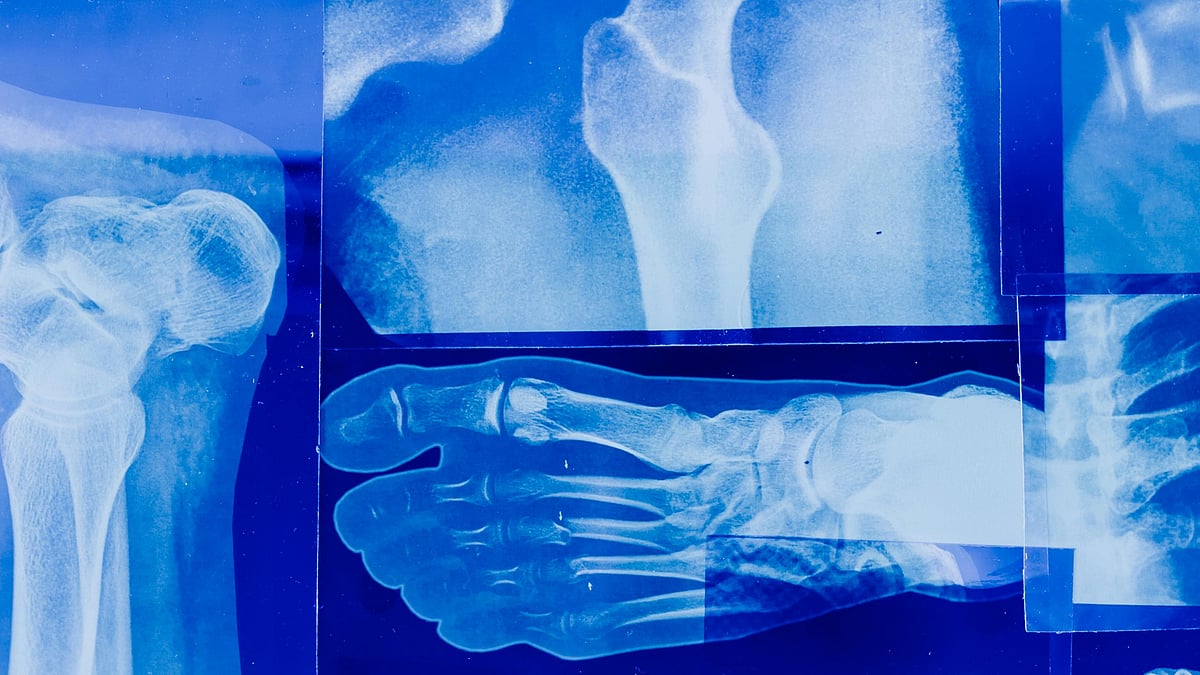 ভাঙা বা টুকরা হয়ে যাওয়া হাড় বিশেষ ধরনের আঠার মাধ্যমে জোড়া লাগানো যাবে