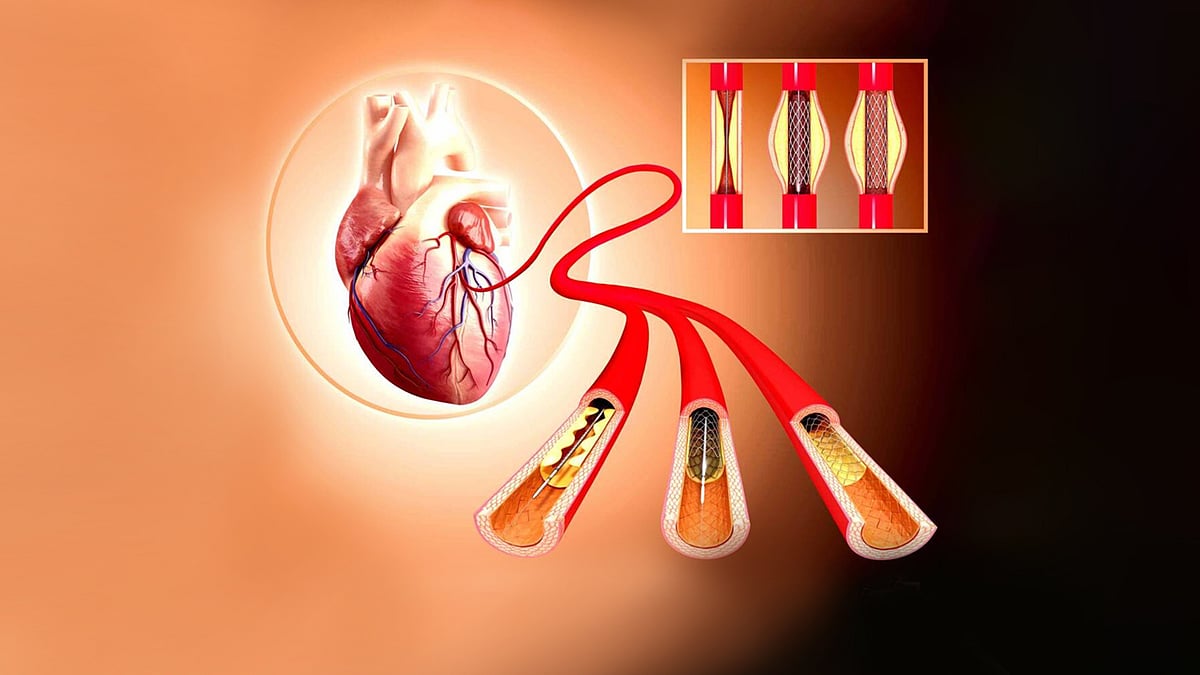 করোনারি এনজিওগ্রাম হৃদ্‌রোগ নির্ণয়ের সফল একটি প্রক্রিয়া, আর সরু হয়ে যাওয়া ধমনি খুলে দেওয়া হয় যে পদ্ধতিতে, তাকেই বলা হয় করোনারি এনজিওপ্লাস্টি