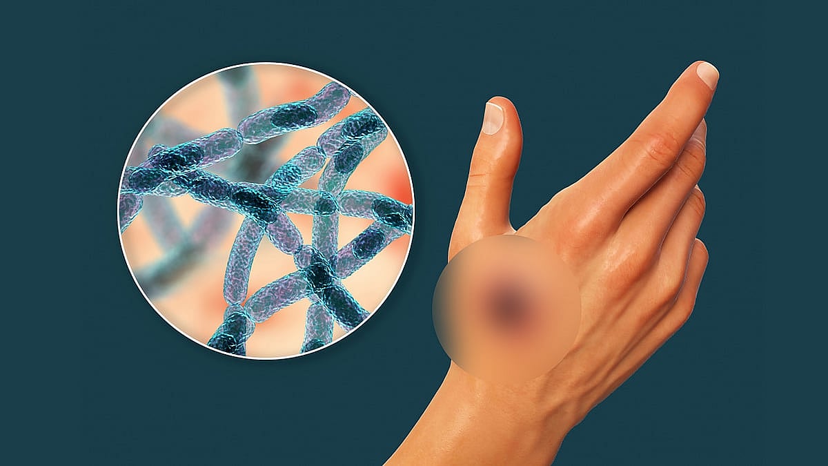 অ্যানথ্রাক্স একজন ব্যক্তির মৃত্যুর কারণ হতে পারে