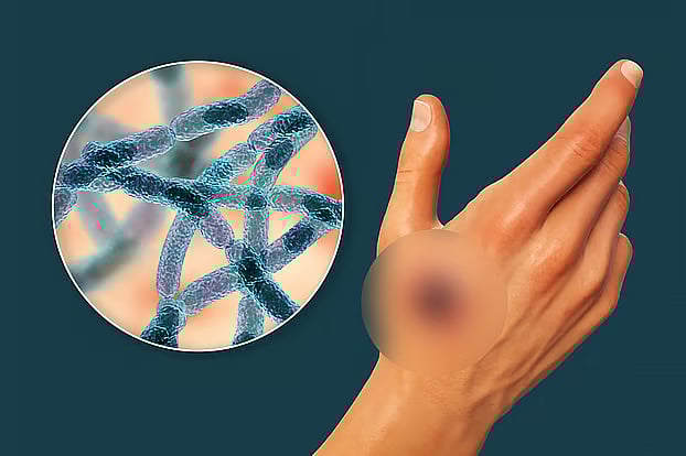 অ্যানথ্রাক্স একজন ব্যক্তির মৃত্যুর কারণ হতে পারে