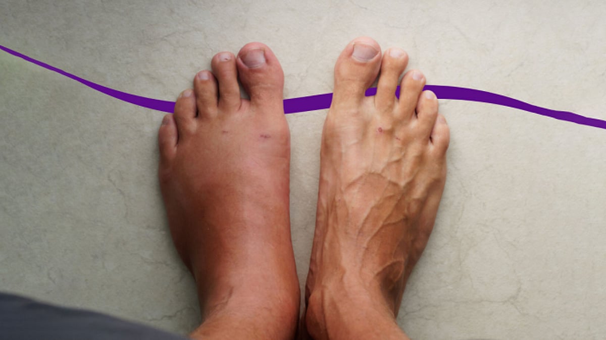 চারকোট আর্থ্রোপ্যাথি পায়ের সন্ধিগুলোর একটি জটিল অবস্থা; দীর্ঘদিনের ডায়াবেটিসের কারণে এতে পায়ের স্নায়ু দুর্বল হয়ে যায়