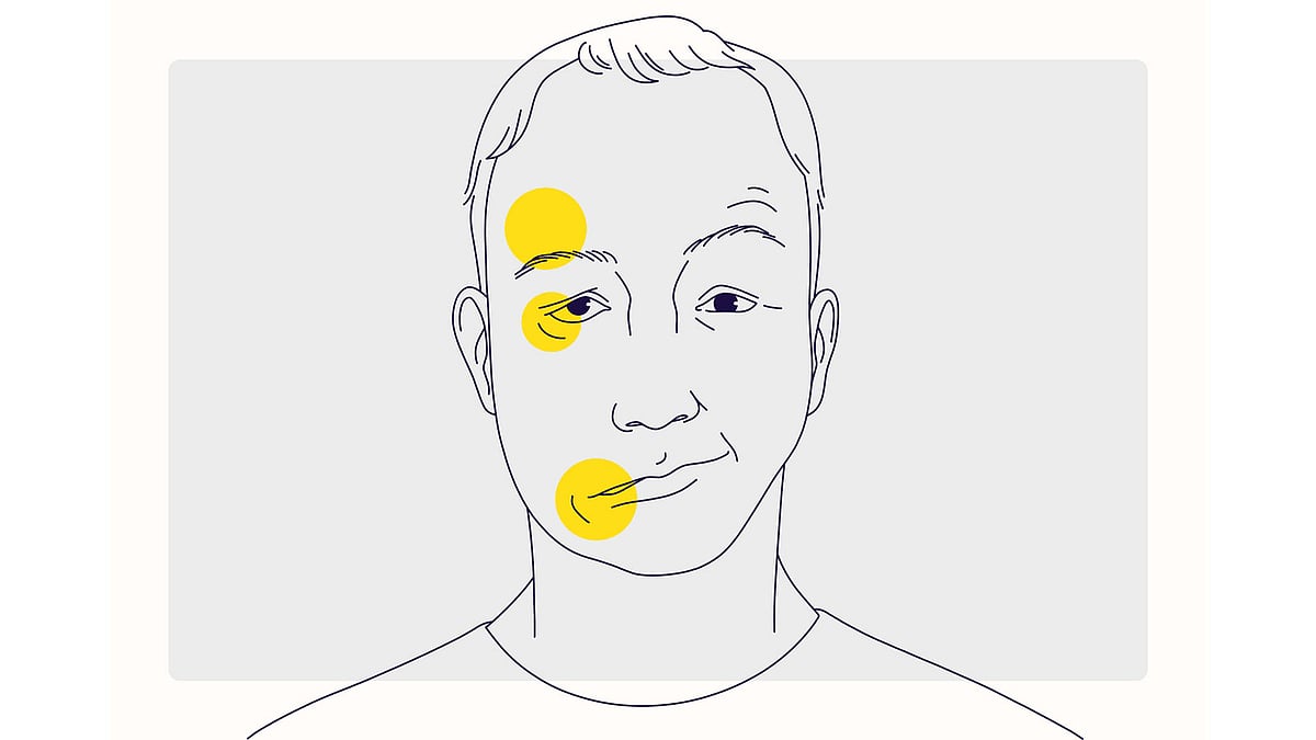 বেলস পালসি, অর্থাৎ মুখের নার্ভের সাময়িক দুর্বলতা