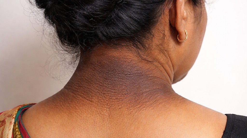 ঘাড়ের এমন কালো দাগ অন্য রোগের আগাম সংকেত হতে পারে