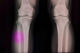 হাড় জোড়া লাগবে জাদুকরি আঠায়