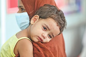 ৫৬ জেলায় হাম ছড়িয়েছে