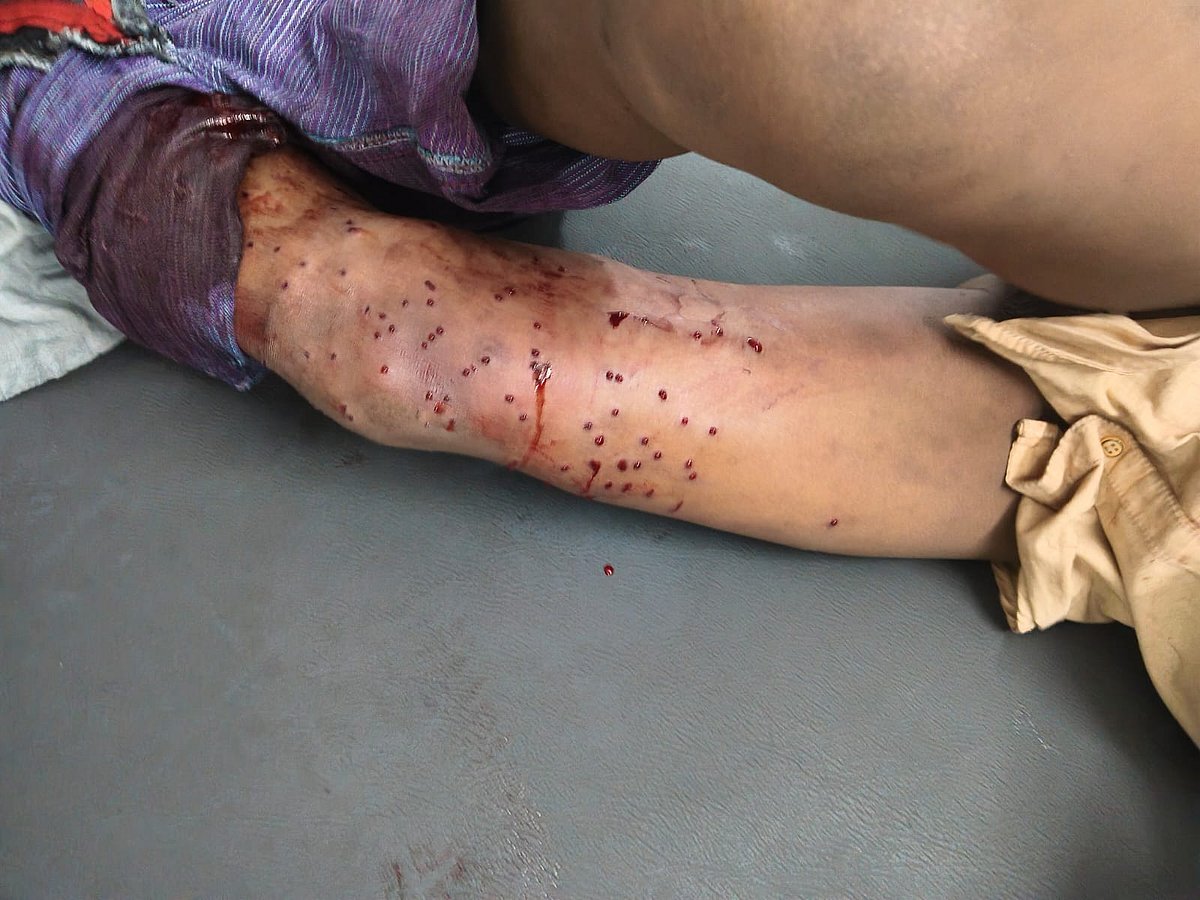 ছররা গুলিতে আহত হয়ে চট্টগ্রাম মেডিকেল কলেজ হাসপাতালে চিকিৎসাধীন এক ব্যক্তি। ৪ এপ্রিল