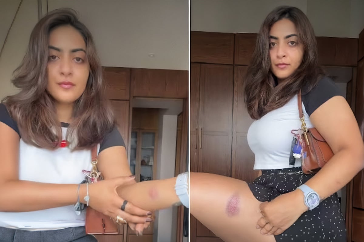 আটকের পর শরীরে আঘাতের দাগ, ছবি প্রকাশ জেইন মেরির