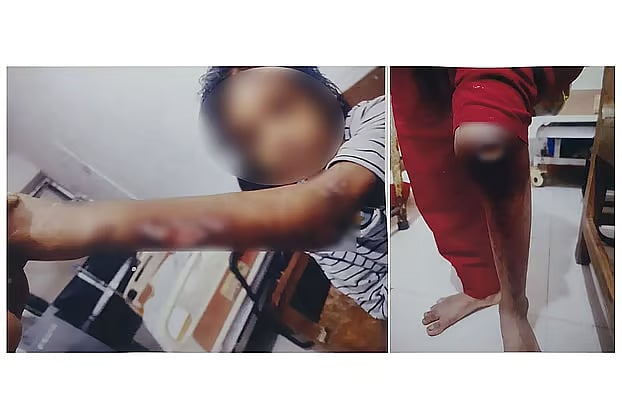 Verbrennungen durch heißen Spatel, Chilipulver in den Augen: ...