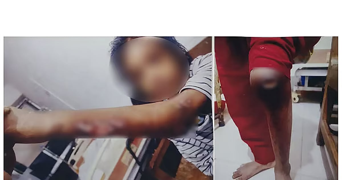 Verbrennungen durch heißen Spatel, Chilipulver in den Augen: ...