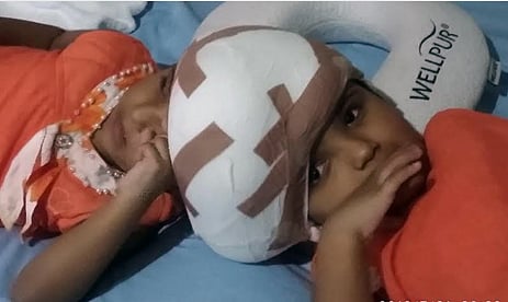 Conjoined twins - Rabeya and Rukaya-who were born with joint heads, are now major risk free after the eighth day of their successful operation at Combined Military Hospital (CMH) in the city. Photo: BSS