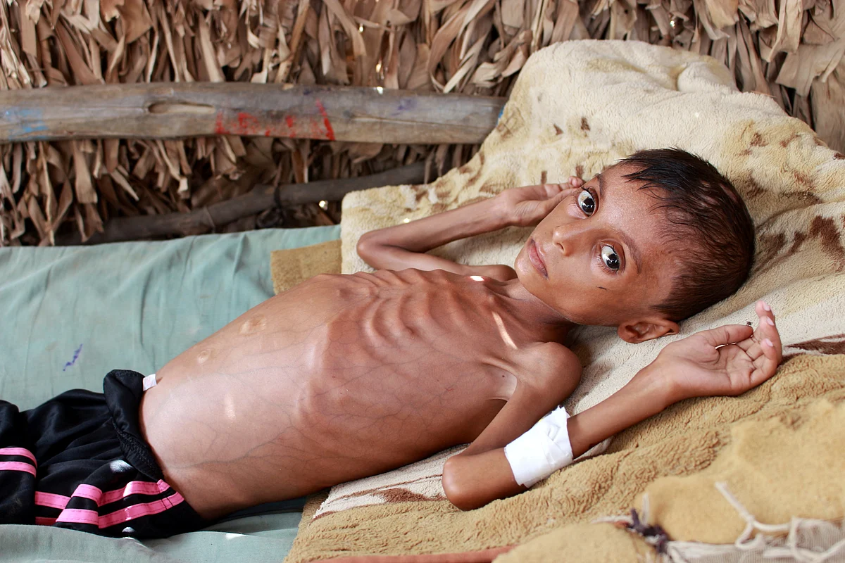 Malnourished boy Hassan Merzam Muhammad, lies on a bed at his house in Abs district of Hajjah province, Yemen 17 July 2020