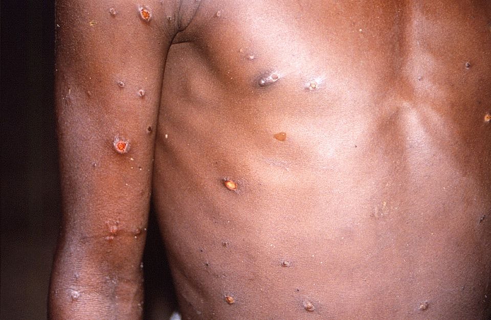 An image created during an investigation into an outbreak of monkeypox, which took place in the Democratic Republic of the Congo, 1996 to 1997, shows the arms and torso of a patient with skin lesions due to monkeypox, in this undated image obtained by Reuters on 18 May this year.
