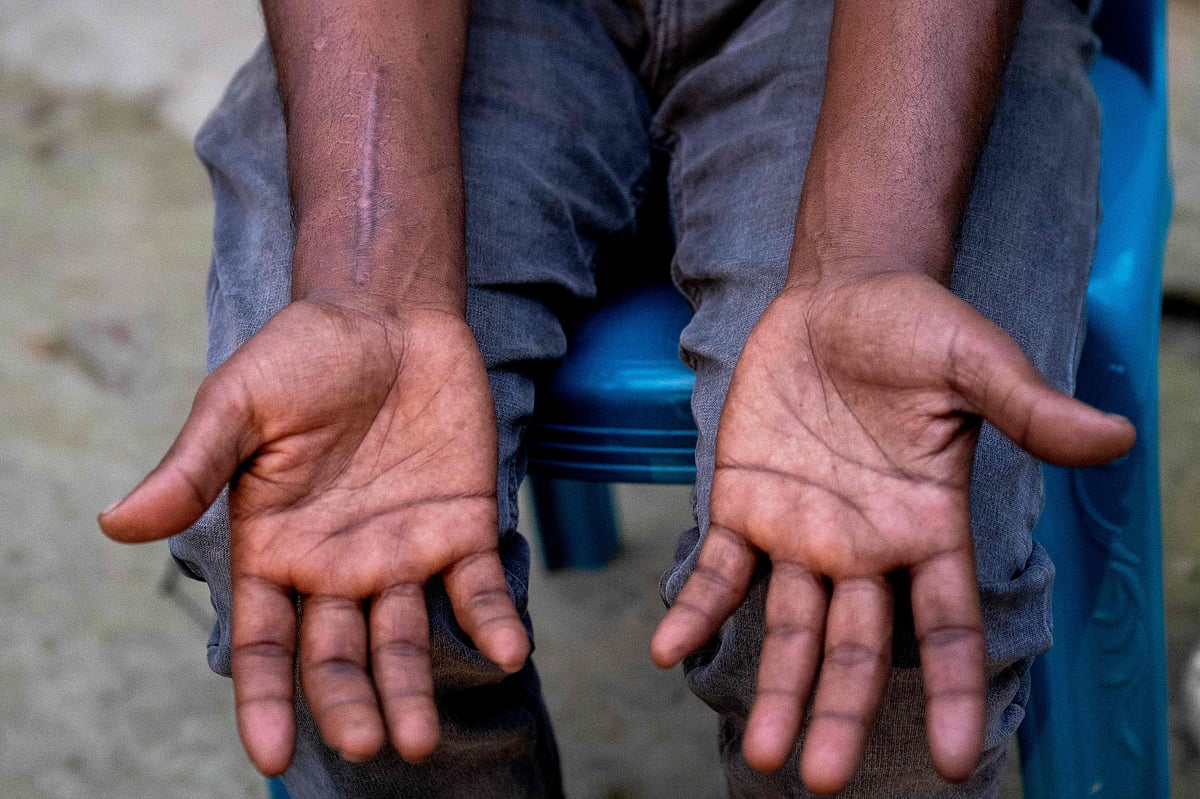 In this photograph taken on 19 February 2025, Mizan Hossain, a former employee at a shipbreaking yard, shows a scar from an injury he sustained in an accident at the yard, on the outskirts of Bangladesh's southern port city of Chittagong.