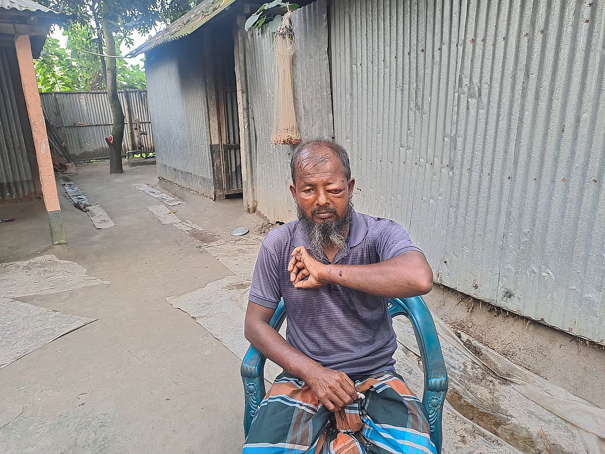 Mozzafar Ali, a 50-year-old farmer from Kishamat Sadar village in Sundarganj upazila of Gaibandha, sits in his yard with a swollen eye and blisters on his left hand. Photo taken on 8 October 2025.