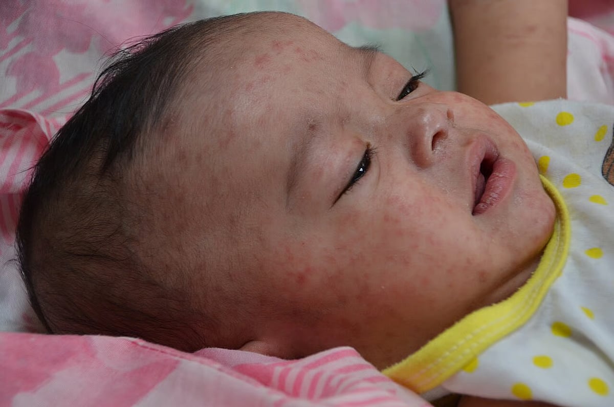 Measles is a disease caused by a highly contagious virus called rubella.