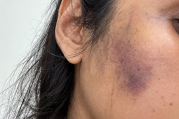 Sumaiya Rahman, who was assaulted. She has visible injuries on her face.