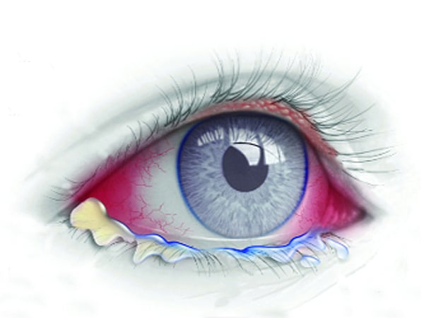 চোখ ওঠা রোগ