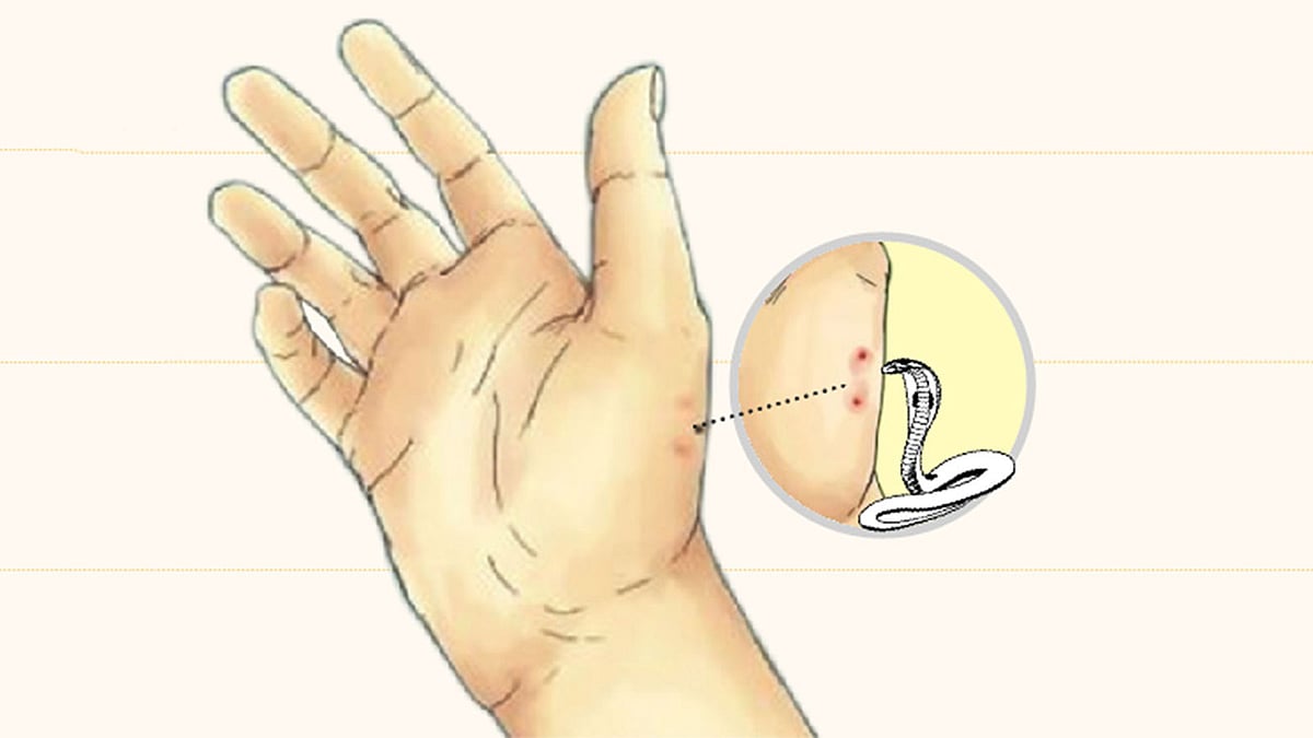 সাপে কাটা